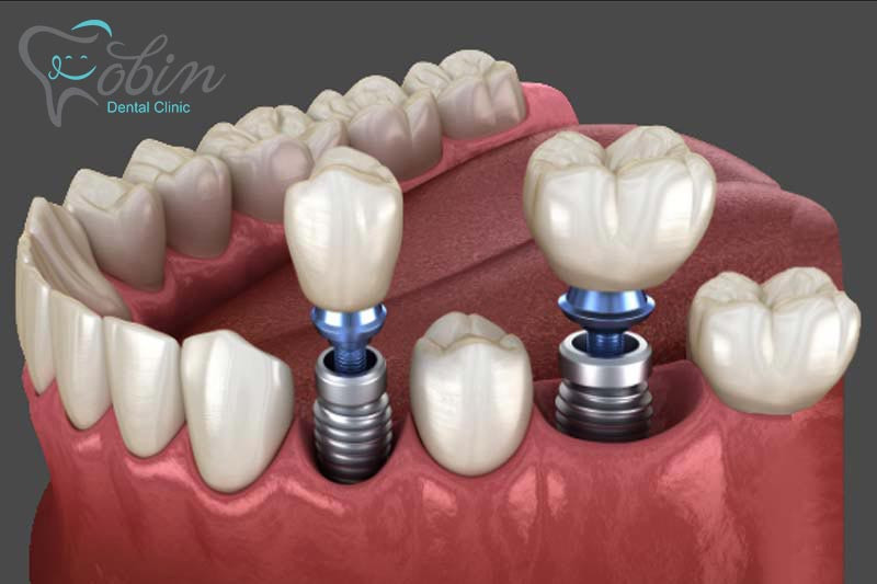 پایه‌های تیتانیومی ایمپلنت، جایگزین ریشه‌های دندان